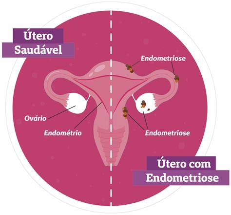 o que é endometriose
